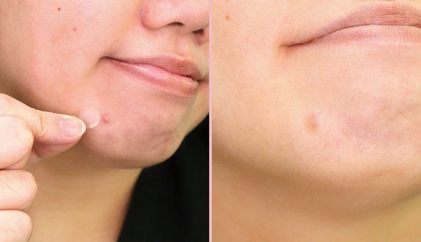 Противовоспалительные локальные патчи против акне  Bye Bye Pimple Patch,  24 шт     Original Korea