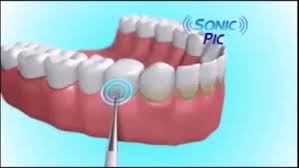 Средство для отбеливания зубов SONIC PIC Gentle at Home Dental Cleaning System