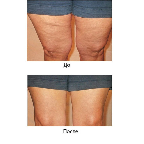 Антицеллюлитный пластырь для похудения INSTANT THIGH LIFT (8 шт). Моментальный лифтинг бёдер, ягодиц