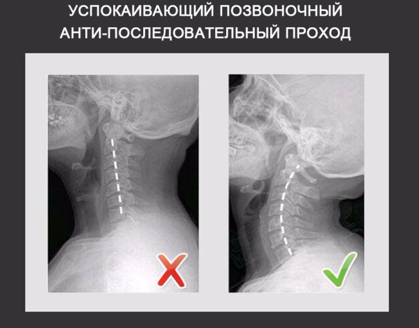 Тренажер для коррекции шейного отдела позвоночника Cervical Vertebrae Physiotherapy Instrument