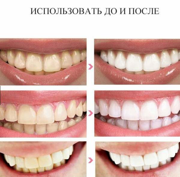 Отбеливающие полоски для зубов 3D White Teeth Whitening Stripes (упаковка: 7 комплектов полосок)